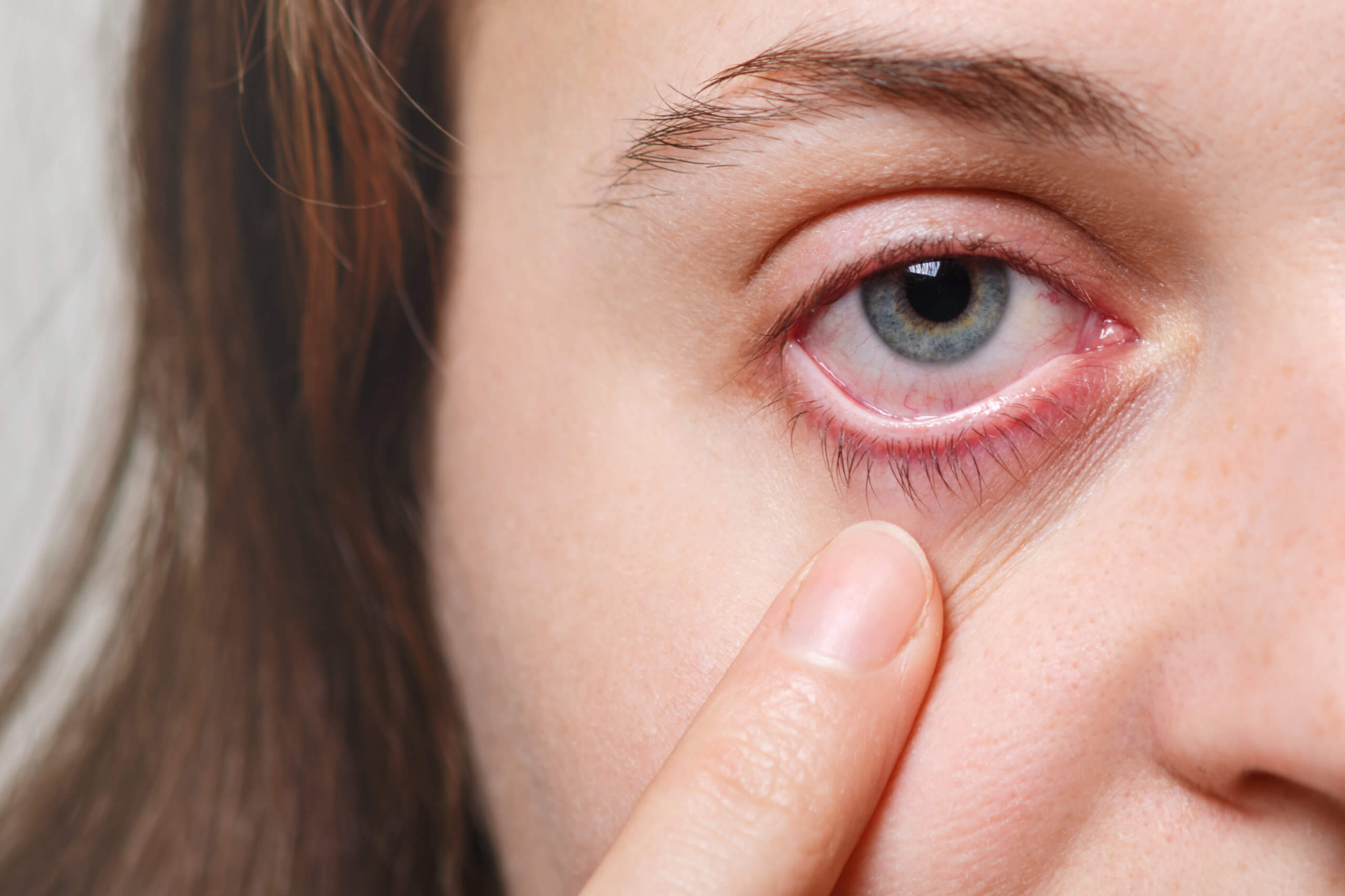 woman with red itchy eyes